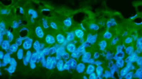 Kreatinkinase